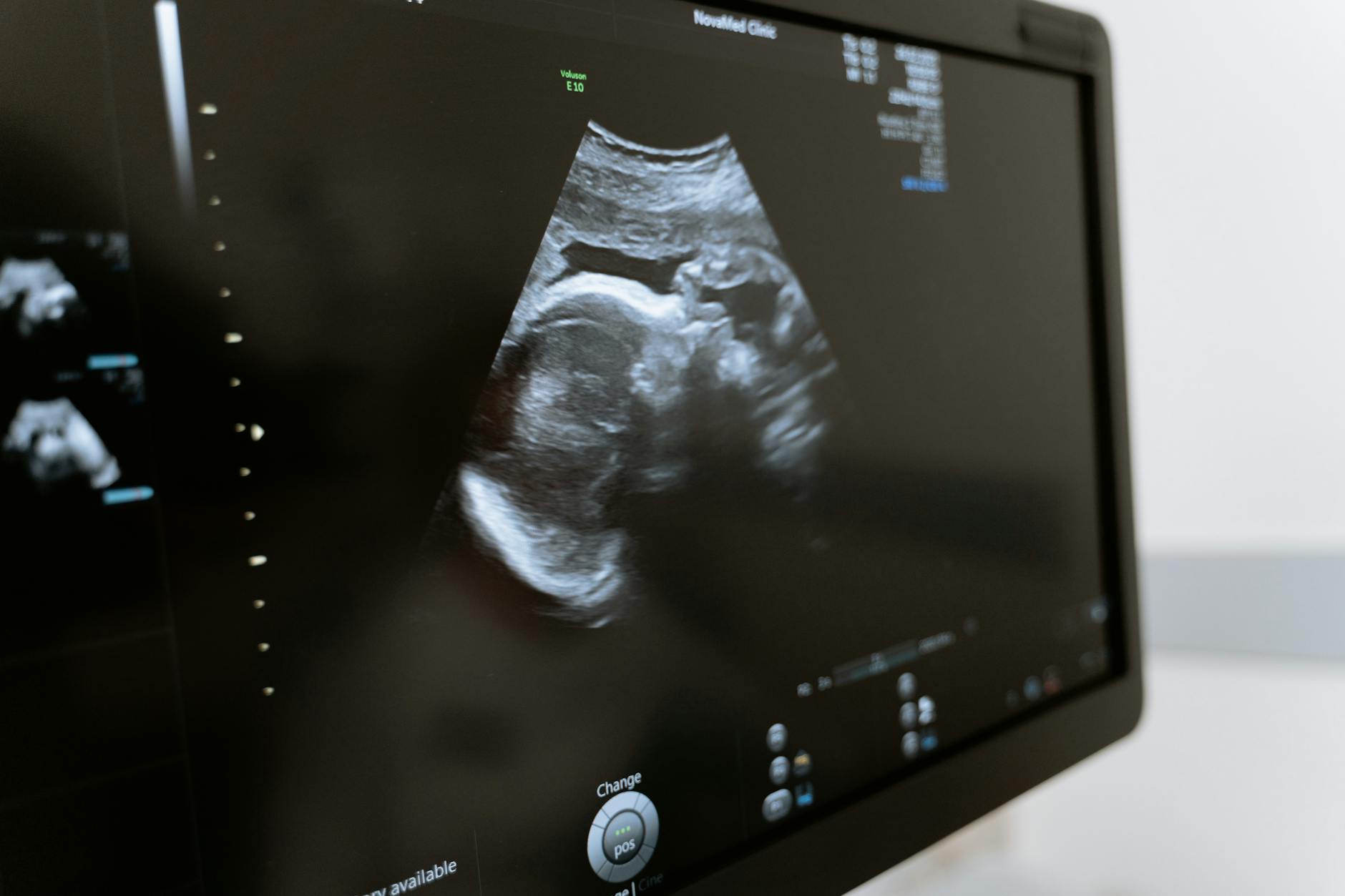 Peritonita — simptome, cauze, diagnostic, tratament